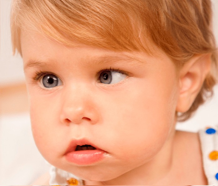 Strabismus Enfocat EN Strabismus enfocat en